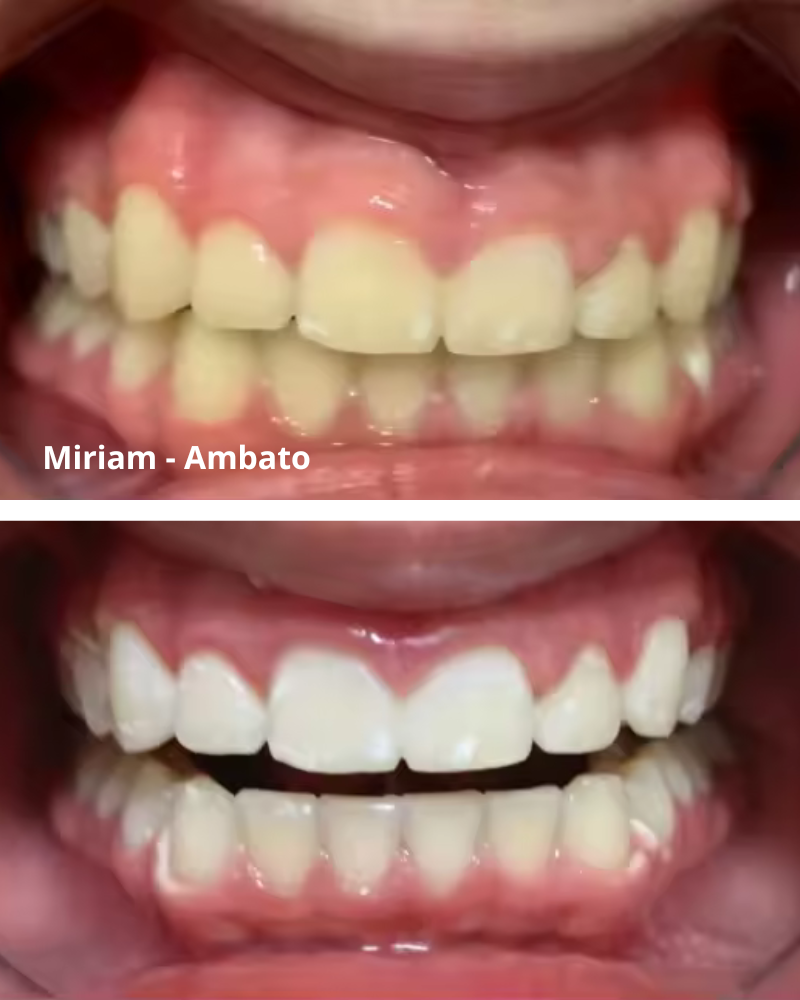 PURPLE SMILE - OPTIENE LA SONRISA QUE SIEMPRE SOÑASTE