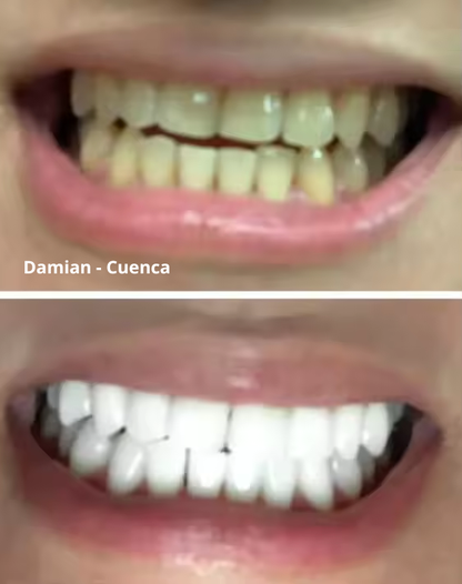 PURPLE SMILE - OPTIENE LA SONRISA QUE SIEMPRE SOÑASTE